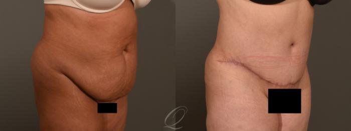 Tummy Tuck Case 1382 Before & After Right Oblique | Serving Rochester, Syracuse & Buffalo, NY | Quatela Center for Plastic Surgery