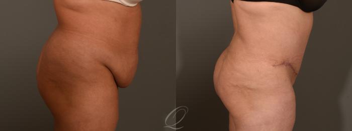 Tummy Tuck Case 1382 Before & After Right Side | Serving Rochester, Syracuse & Buffalo, NY | Quatela Center for Plastic Surgery