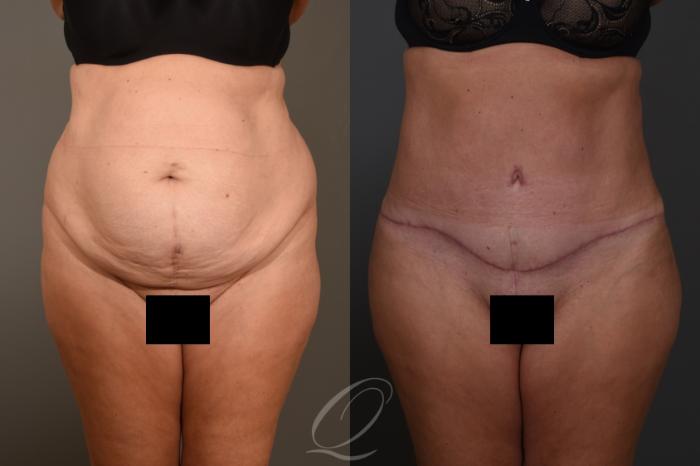 Tummy Tuck Case 1383 Before & After Front | Serving Rochester, Syracuse & Buffalo, NY | Quatela Center for Plastic Surgery