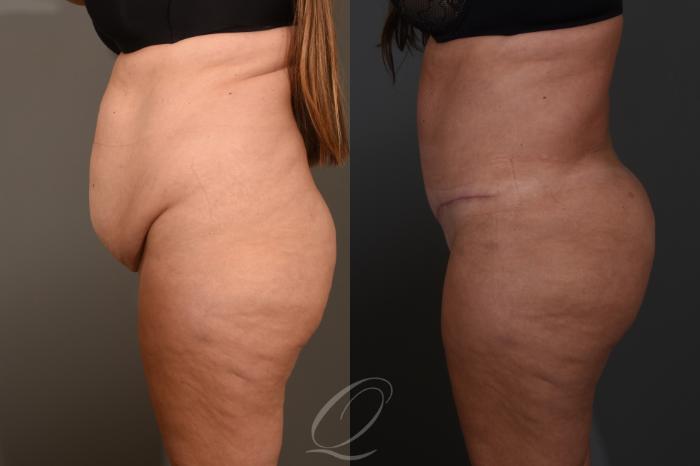 Tummy Tuck Case 1383 Before & After Left Side | Serving Rochester, Syracuse & Buffalo, NY | Quatela Center for Plastic Surgery