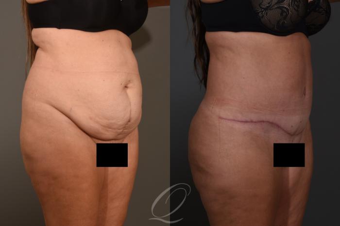 Tummy Tuck Case 1383 Before & After Right Oblique | Serving Rochester, Syracuse & Buffalo, NY | Quatela Center for Plastic Surgery