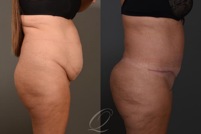 Tummy Tuck Case 1383 Before & After Right Side | Serving Rochester, Syracuse & Buffalo, NY | Quatela Center for Plastic Surgery