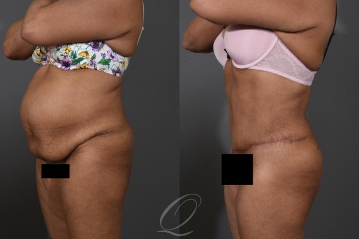 Tummy Tuck Case 1384 Before & After Left Oblique | Serving Rochester, Syracuse & Buffalo, NY | Quatela Center for Plastic Surgery