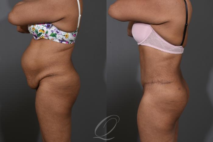Tummy Tuck Case 1384 Before & After Left Side | Serving Rochester, Syracuse & Buffalo, NY | Quatela Center for Plastic Surgery