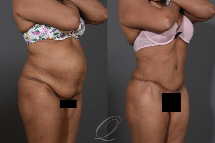 Tummy Tuck Case 1384 Before & After Right Oblique | Serving Rochester, Syracuse & Buffalo, NY | Quatela Center for Plastic Surgery