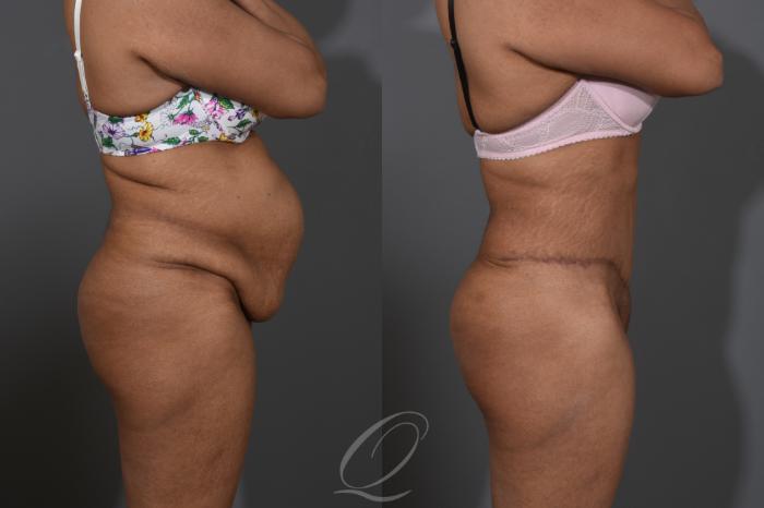 Tummy Tuck Case 1384 Before & After Right Side | Serving Rochester, Syracuse & Buffalo, NY | Quatela Center for Plastic Surgery
