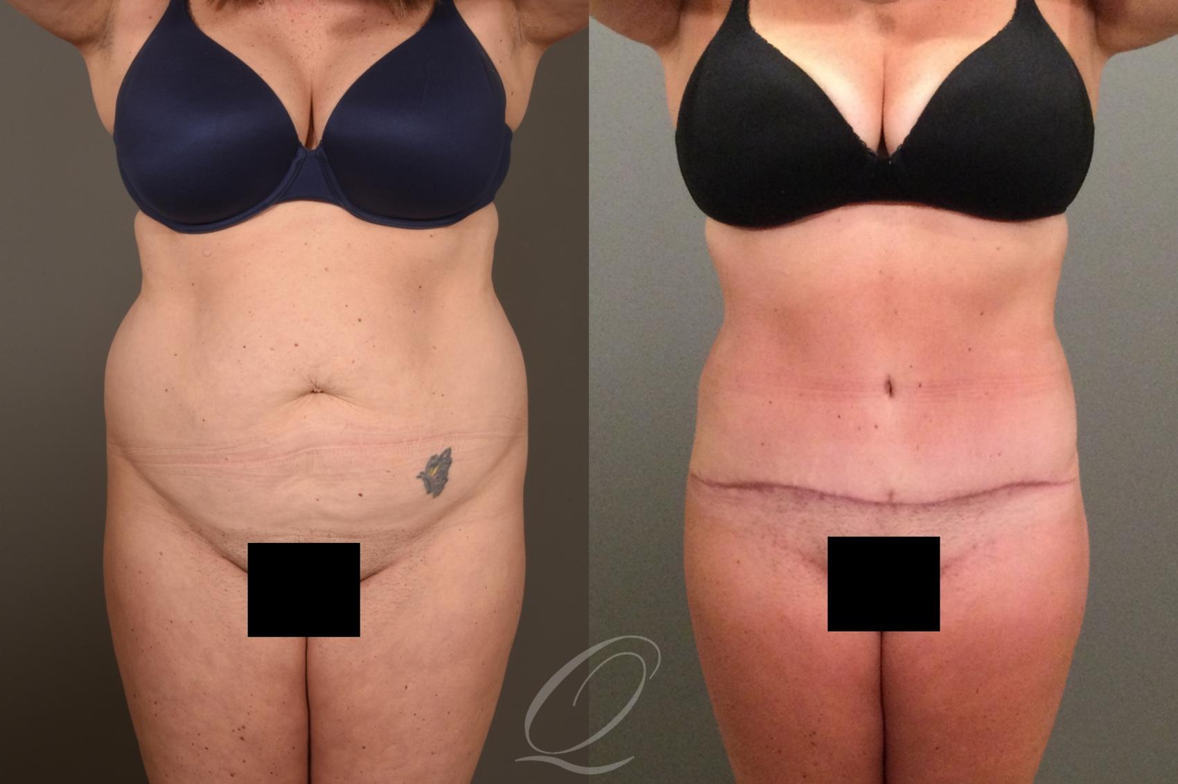 Tummy Tuck Case 1407 Before & After Front | Serving Rochester, Syracuse & Buffalo, NY | Quatela Center for Plastic Surgery