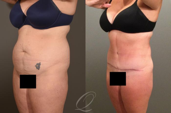 Tummy Tuck Case 1407 Before & After Left Oblique | Serving Rochester, Syracuse & Buffalo, NY | Quatela Center for Plastic Surgery