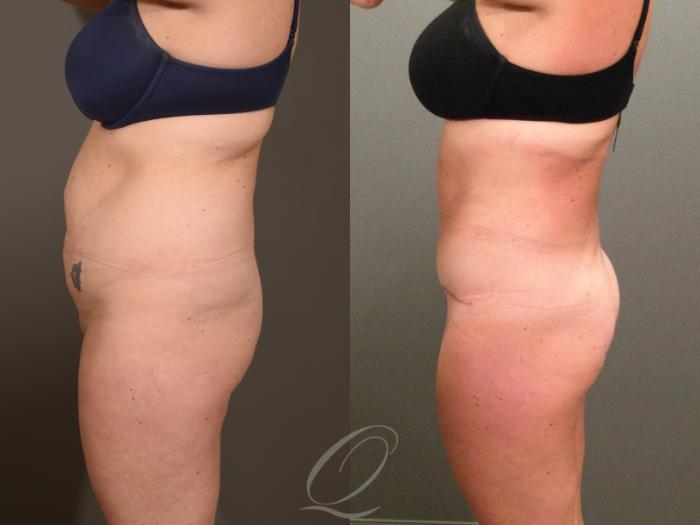 Tummy Tuck Case 1407 Before & After Left Side | Serving Rochester, Syracuse & Buffalo, NY | Quatela Center for Plastic Surgery