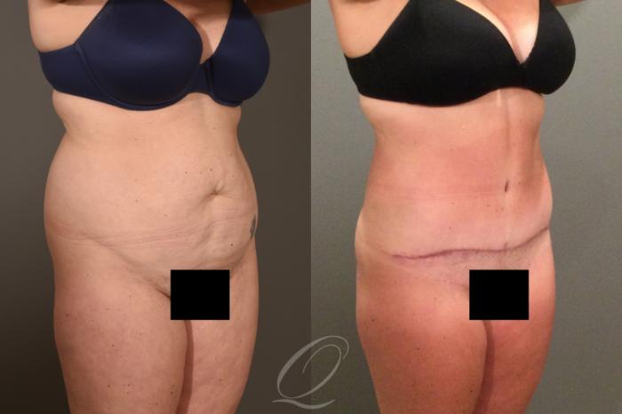 Tummy Tuck Case 1407 Before & After Right Oblique | Serving Rochester, Syracuse & Buffalo, NY | Quatela Center for Plastic Surgery