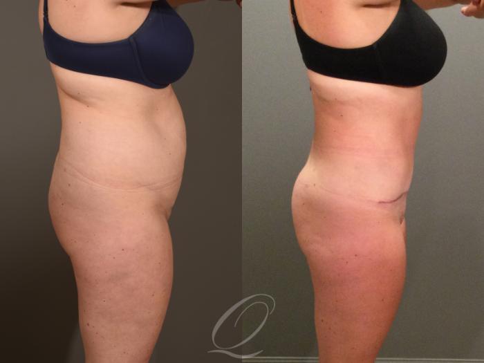 Tummy Tuck Case 1407 Before & After Right Side | Serving Rochester, Syracuse & Buffalo, NY | Quatela Center for Plastic Surgery