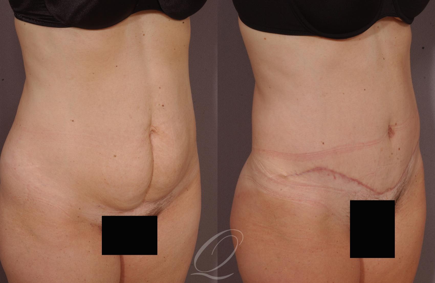 Tummy Tuck Case 147 Before & After View #1 | Serving Rochester, Syracuse & Buffalo, NY | Quatela Center for Plastic Surgery