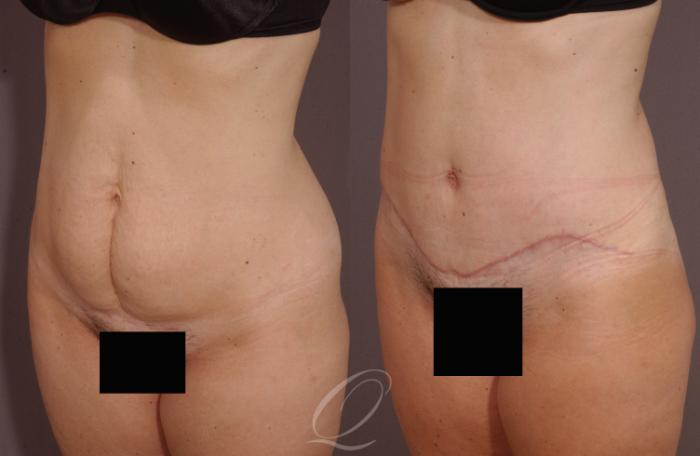 Tummy Tuck Case 147 Before & After View #2 | Serving Rochester, Syracuse & Buffalo, NY | Quatela Center for Plastic Surgery