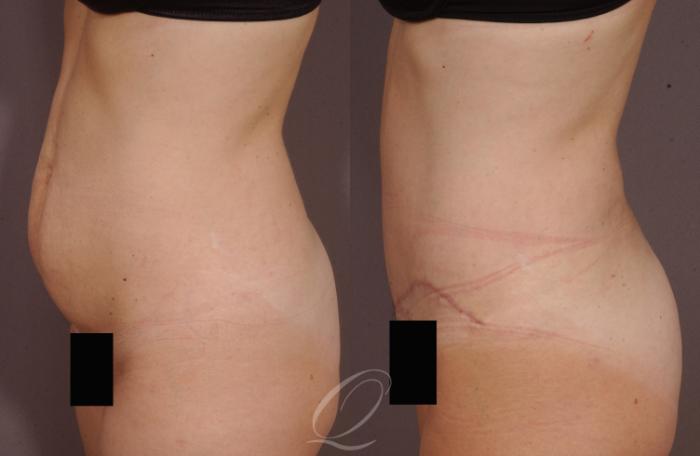 Tummy Tuck Case 147 Before & After View #3 | Serving Rochester, Syracuse & Buffalo, NY | Quatela Center for Plastic Surgery