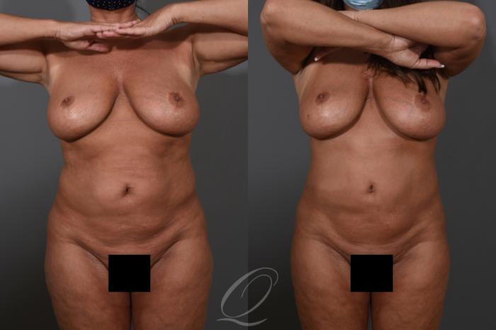 Bra Line Back Lift Case 1478 Before & After Front | Serving Rochester, Syracuse & Buffalo, NY | Quatela Center for Plastic Surgery