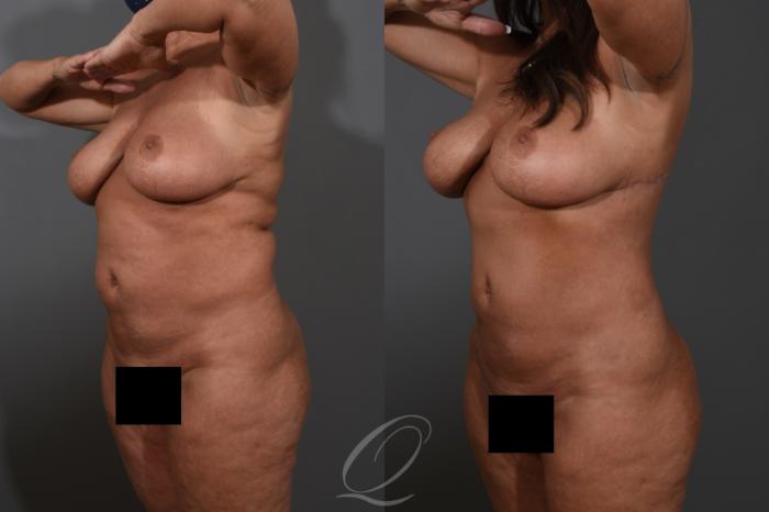 Bra Line Back Lift Case 1478 Before & After Left Oblique | Serving Rochester, Syracuse & Buffalo, NY | Quatela Center for Plastic Surgery