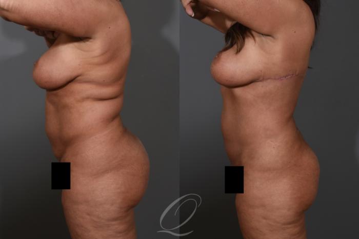 Bra Line Back Lift Case 1478 Before & After Left Side | Serving Rochester, Syracuse & Buffalo, NY | Quatela Center for Plastic Surgery