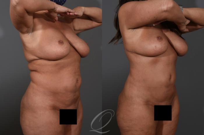 Tummy Tuck Case 1478 Before & After Right Oblique | Serving Rochester, Syracuse & Buffalo, NY | Quatela Center for Plastic Surgery