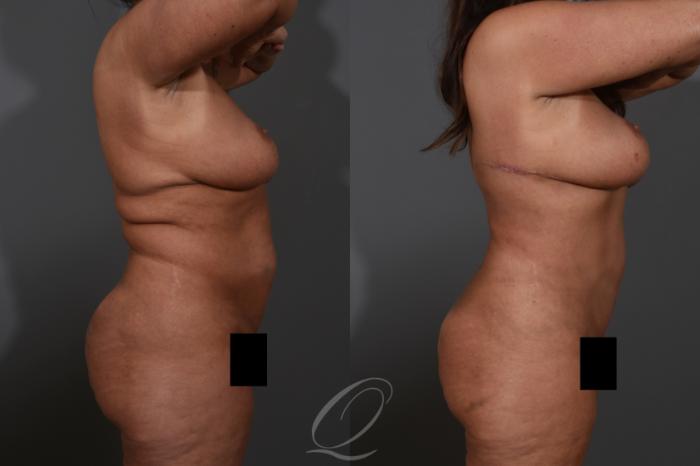 Tummy Tuck Case 1478 Before & After Right Side | Serving Rochester, Syracuse & Buffalo, NY | Quatela Center for Plastic Surgery