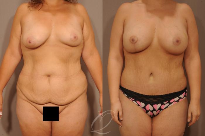 Tummy Tuck Case 1479 Before & After Additional Front View | Serving Rochester, Syracuse & Buffalo, NY | Quatela Center for Plastic Surgery