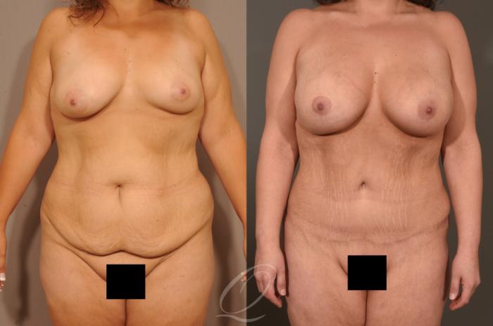 Tummy Tuck Case 1479 Before & After Front | Serving Rochester, Syracuse & Buffalo, NY | Quatela Center for Plastic Surgery