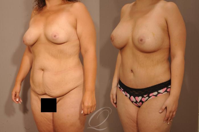 Tummy Tuck Case 1479 Before & After Left Oblique | Serving Rochester, Syracuse & Buffalo, NY | Quatela Center for Plastic Surgery