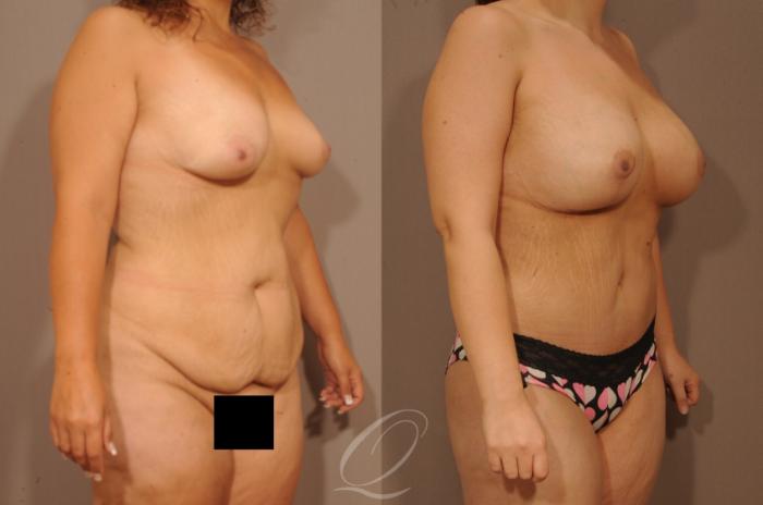 Tummy Tuck Case 1479 Before & After Right Oblique | Serving Rochester, Syracuse & Buffalo, NY | Quatela Center for Plastic Surgery