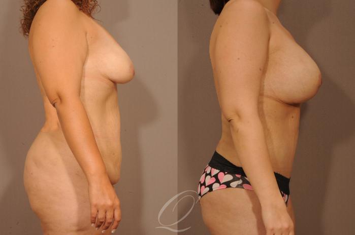 Tummy Tuck Case 1479 Before & After Right Side | Serving Rochester, Syracuse & Buffalo, NY | Quatela Center for Plastic Surgery