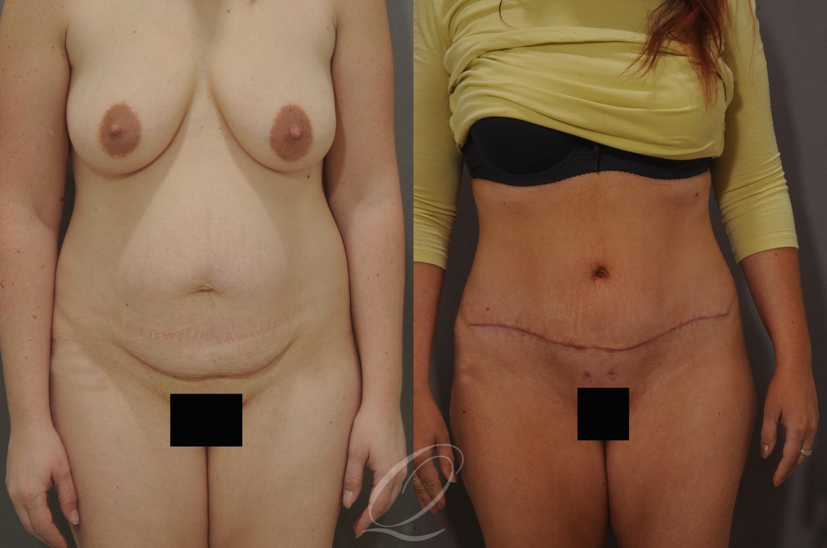 Tummy Tuck Case 148 Before & After View #1 | Serving Rochester, Syracuse & Buffalo, NY | Quatela Center for Plastic Surgery