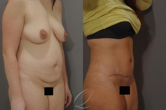 Tummy Tuck Case 148 Before & After View #2 | Serving Rochester, Syracuse & Buffalo, NY | Quatela Center for Plastic Surgery