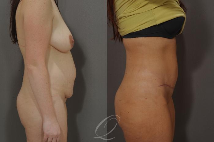 Tummy Tuck Case 148 Before & After View #3 | Serving Rochester, Syracuse & Buffalo, NY | Quatela Center for Plastic Surgery