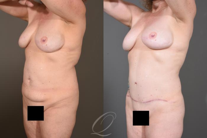 Tummy Tuck Case 1480 Before & After Left Oblique | Serving Rochester, Syracuse & Buffalo, NY | Quatela Center for Plastic Surgery