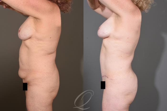 Breast Augmentation with Fat Transfer Case 1480 Before & After Left Side | Serving Rochester, Syracuse & Buffalo, NY | Quatela Center for Plastic Surgery