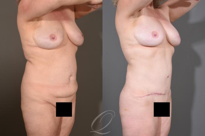 Tummy Tuck Case 1480 Before & After Right Oblique | Serving Rochester, Syracuse & Buffalo, NY | Quatela Center for Plastic Surgery
