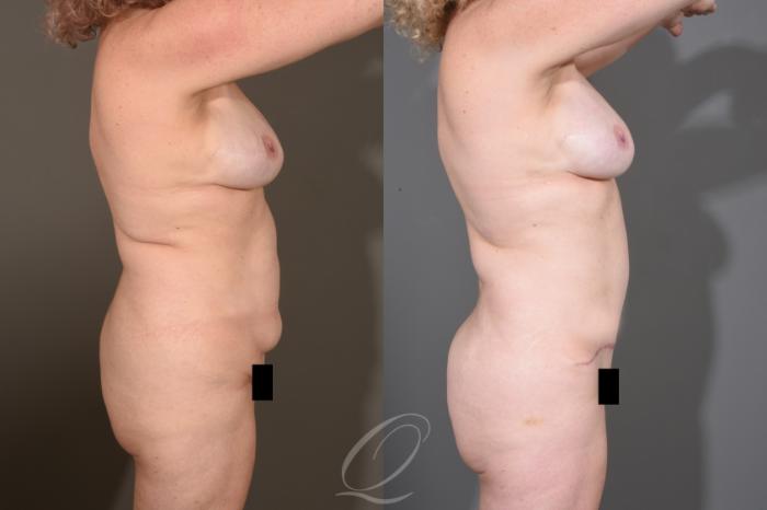 Tummy Tuck Case 1480 Before & After Right Side | Serving Rochester, Syracuse & Buffalo, NY | Quatela Center for Plastic Surgery