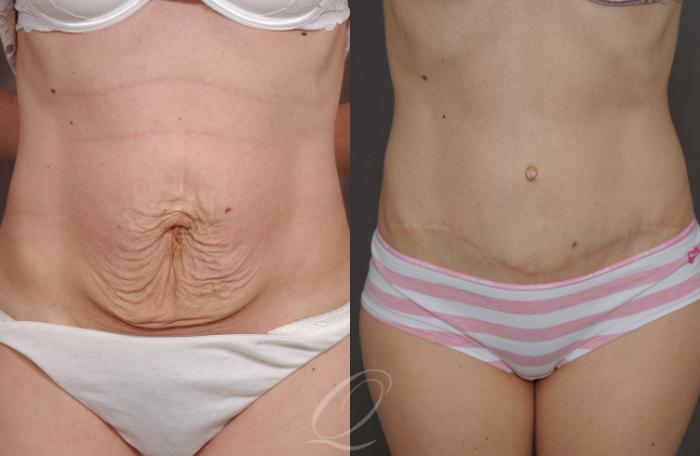 Tummy Tuck Case 150 Before & After View #1 | Serving Rochester, Syracuse & Buffalo, NY | Quatela Center for Plastic Surgery