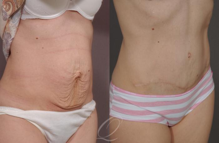 Tummy Tuck Case 150 Before & After View #2 | Serving Rochester, Syracuse & Buffalo, NY | Quatela Center for Plastic Surgery