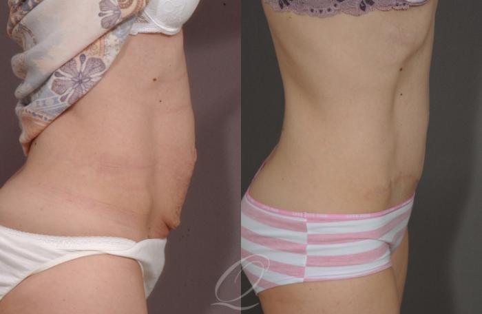 Tummy Tuck Case 150 Before & After View #3 | Serving Rochester, Syracuse & Buffalo, NY | Quatela Center for Plastic Surgery