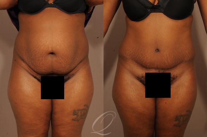 Tummy Tuck Case 1509 Before & After View #1 | Serving Rochester, Syracuse & Buffalo, NY | Quatela Center for Plastic Surgery