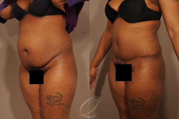 Tummy Tuck Case 1509 Before & After View #2 | Serving Rochester, Syracuse & Buffalo, NY | Quatela Center for Plastic Surgery