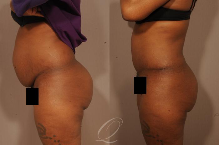 Tummy Tuck Case 1509 Before & After View #3 | Serving Rochester, Syracuse & Buffalo, NY | Quatela Center for Plastic Surgery