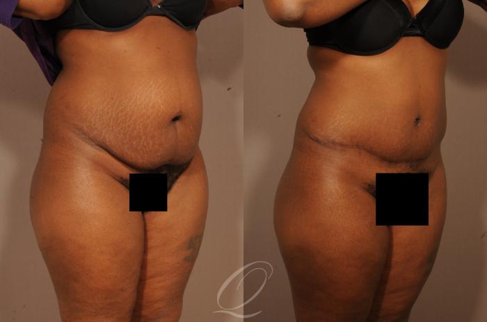 Tummy Tuck Case 1509 Before & After View #4 | Serving Rochester, Syracuse & Buffalo, NY | Quatela Center for Plastic Surgery