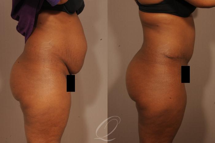 Tummy Tuck Case 1509 Before & After View #5 | Serving Rochester, Syracuse & Buffalo, NY | Quatela Center for Plastic Surgery
