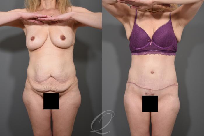 Tummy Tuck Case 1511 Before & After View #1 | Serving Rochester, Syracuse & Buffalo, NY | Quatela Center for Plastic Surgery