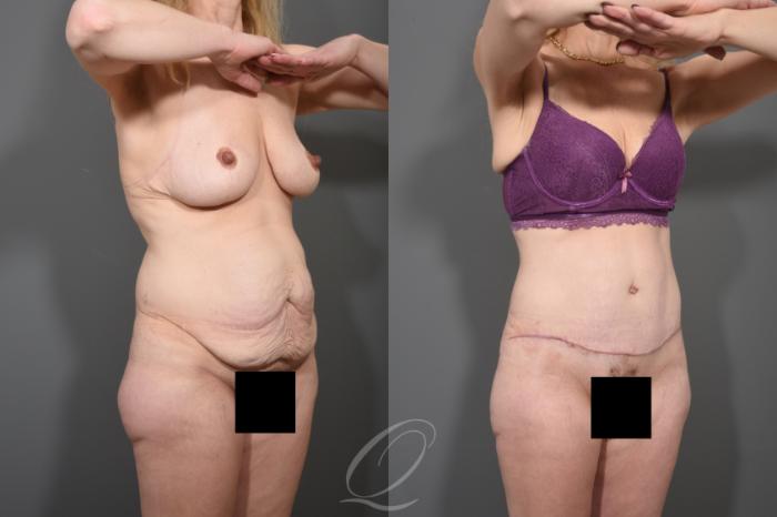 Tummy Tuck Case 1511 Before & After View #2 | Serving Rochester, Syracuse & Buffalo, NY | Quatela Center for Plastic Surgery
