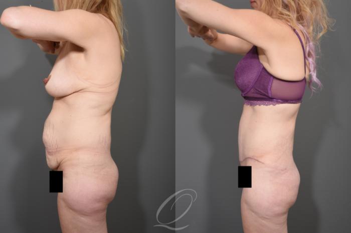 Tummy Tuck Case 1511 Before & After View #3 | Serving Rochester, Syracuse & Buffalo, NY | Quatela Center for Plastic Surgery