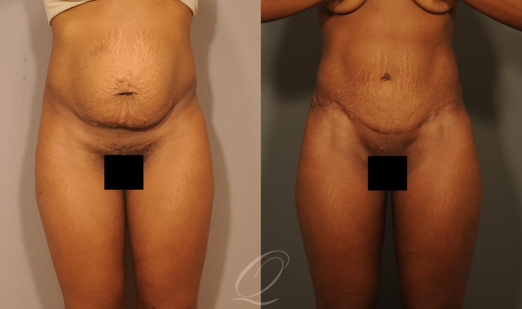 Tummy Tuck Case 1513 Before & After View #1 | Serving Rochester, Syracuse & Buffalo, NY | Quatela Center for Plastic Surgery