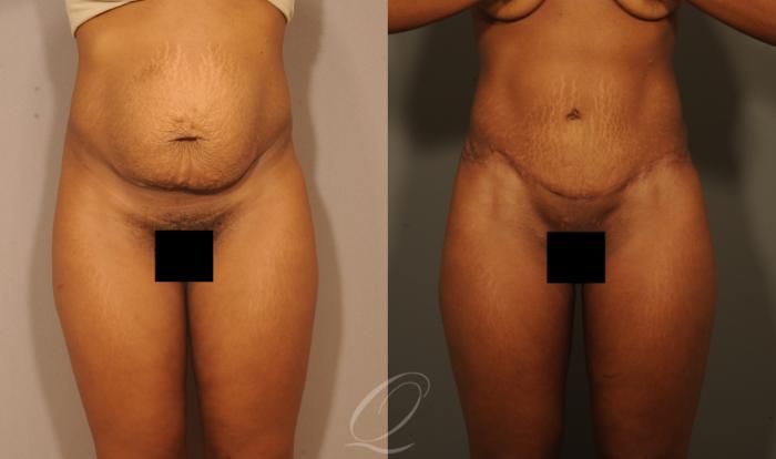 Tummy Tuck Case 1513 Before & After View #1 | Serving Rochester, Syracuse & Buffalo, NY | Quatela Center for Plastic Surgery