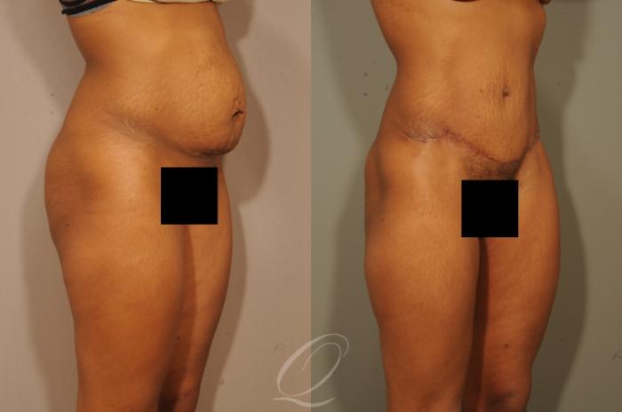 Tummy Tuck Case 1513 Before & After View #2 | Serving Rochester, Syracuse & Buffalo, NY | Quatela Center for Plastic Surgery