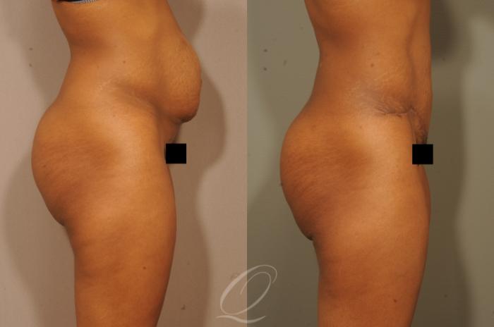 Tummy Tuck Case 1513 Before & After View #3 | Serving Rochester, Syracuse & Buffalo, NY | Quatela Center for Plastic Surgery